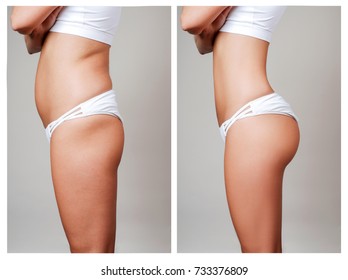 Female body before and after liposuction. Plastic surgery concept.