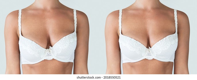 Female breast comparison before and after breast asymmetry correction surgery 