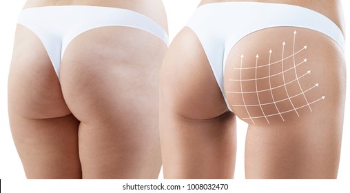 Female buttocks with arrows grid before and after plastic surgery. - Shutterstock ID 1008032470