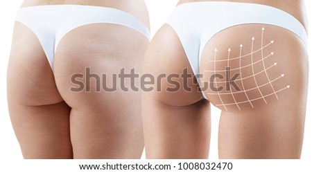 Female buttocks with arrows grid before and after plastic surgery.