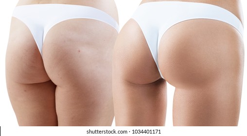 Female buttocks before and after anti-cellulite treatment. - Shutterstock ID 1034401171