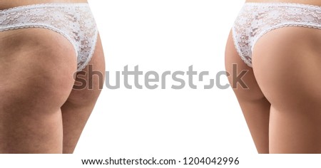 Female buttocks before and after treatmen with copy space. Isolated on white background.