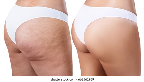 Female buttocks before and after treatment. - Shutterstock ID 662561989