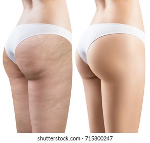 Female buttocks before and after treatment.