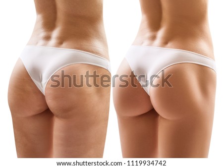 Female buttocks before and after treatment. Isolated on white.