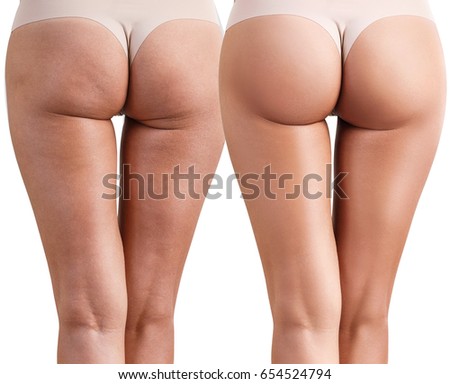 Female buttocks before and after treatment.