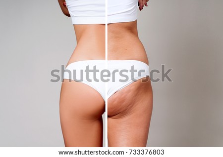 Female buttocks before and after treatment. Plastic surgery concept.