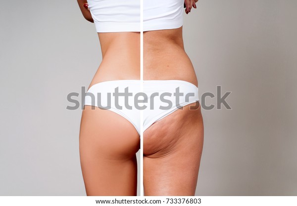 Female buttocks before and after treatment.\
Plastic surgery concept.
