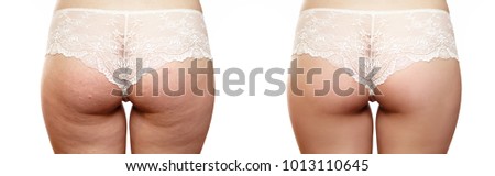 Female buttocks with cellulite before and after on a white background, close-up, after a medical procedure, beautiful female pop, skin defects, solution, white lace panties, cellulite, retouch
