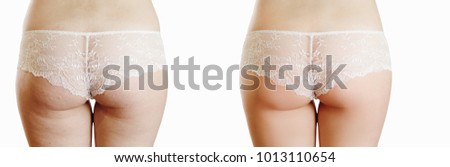 Female buttocks with cellulite before and after on a white background, close-up, after a medical procedure, beautiful female pop, skin defects, solution, cellulite, retouch