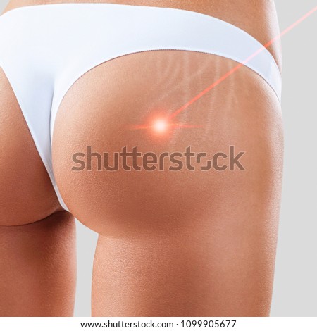 Female buttocks with laser ray removes stretchmarks.