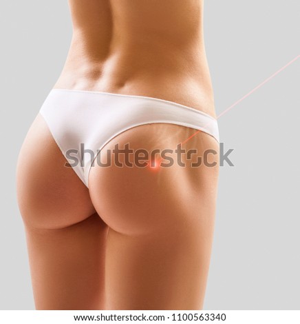Female buttocks with laser ray removes stretchmarks.