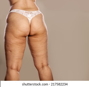 Mature saggy ass Skin Cellulitis Hd Stock Images Shutterstock