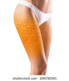 Female Buttocks With Orange Peel Texture.