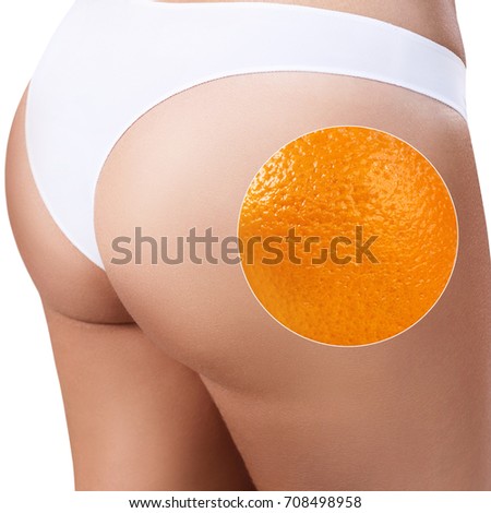 Female buttocks with zoom circle shows orange peel