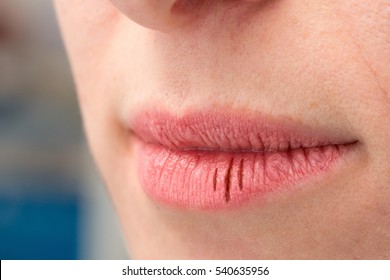 Female With Chapped Lips