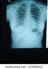 Female Chest Radiograph Of A Patient That Had Road Traffic Accident