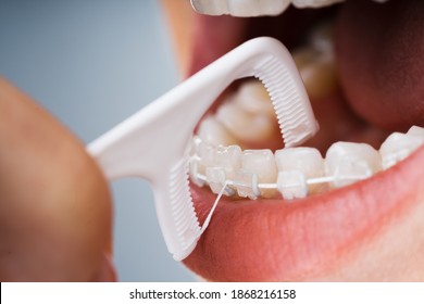 Female Cleaning Dental Brackets In Mouth Using Floss Stick