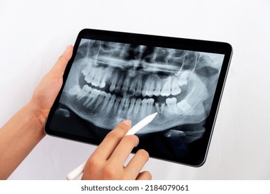 female dentist shows the patient his x-ray, the x-ray is of an old young male female and explains the procedure and treatment he will receive on his teeth, the x-ray shows the damage to the teeth. - Powered by Shutterstock