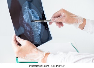 Female Doctor Analyzing Mammography Results On X-ray.