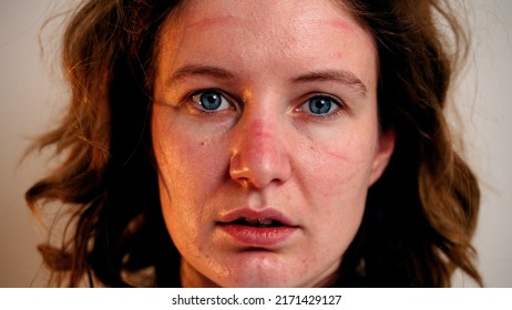 Female Doctor During Coronavirus Pandemic Covid-19 Takes Off Glasses, Hood From Protective Suit And Mask, Face Marks Are Visible, Red Spots. Nurse Inhales And Exhales Air With Relief.Close Up Portrait