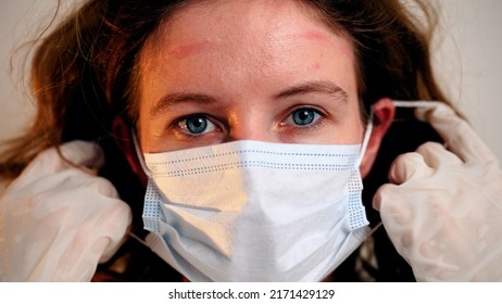 Female Doctor During Coronavirus Pandemic Covid-19 Takes Off Glasses, Hood From Protective Suit And Mask, Face Marks Are Visible, Red Spots. Nurse Inhales And Exhales Air With Relief.Close Up Portrait