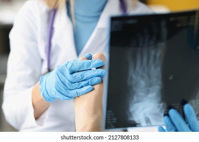 Female Doctor Examines X-ray Of Patient Legs. Foot Injury And Sprain Concept