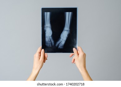 Female doctor examining x-ray image of legs of newborn baby. Isolated over gray background