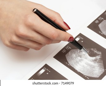 Female Doctor Pointing At An Ultrasound Analysis Of An Ovary