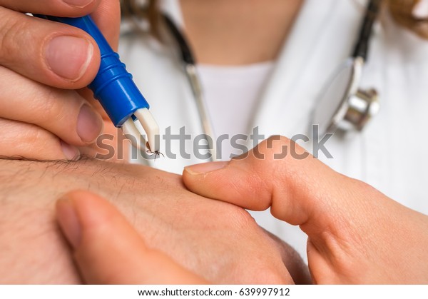 Female doctor\
removing a tick with tweezers from hand of patient. Encephalitis,\
borreliosis and lyme\
disease.