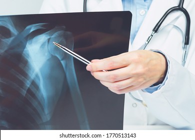 Female Doctors Hand Pointing At X-ray Medical Imaging With A Shoulder Condition. Bone Health, Impingement. Orthopedics Medicine. Healthcare And Medicine. Injury. SLAP Lesion