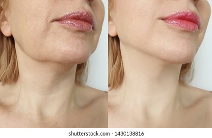 female double chin   after correction