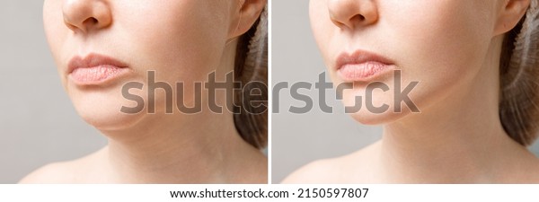 Female double chin before
and after correction. Correction of the chin shape liposuction of
the neck. The result of the procedure in the clinic of aesthetic
medicine.
