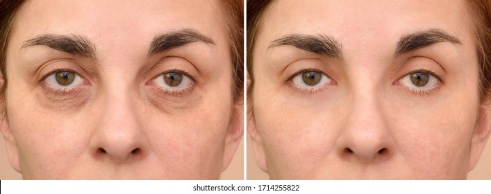 Female Eye Bags Before And After Cosmetic Treatment Or Plastic Procedure, Blepharoplasty. Close-up.