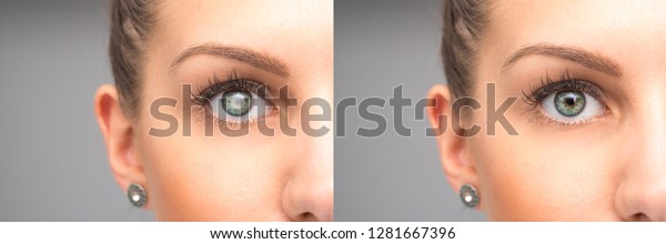 Female Eye Before After Cataract Removal Stock Photo (Edit Now) 1281667396