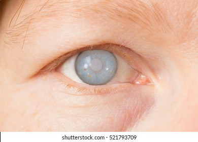 Female Eye With Cataract