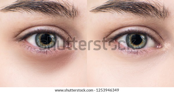 Female Eyes Bruises Under Eyes Before Stock Photo (Edit Now) 1253946349