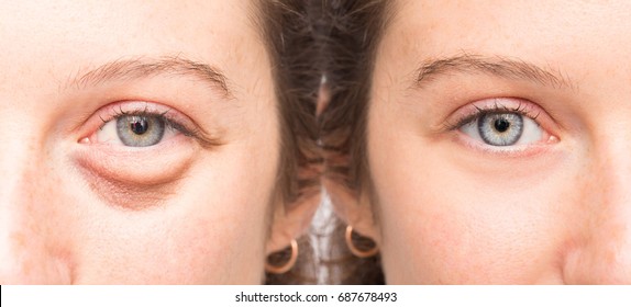 Female Face Before And After Blepharoplsty With And Without Eye Bag