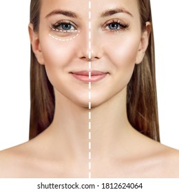 Female Face Before And After Plastic Surgery Anti Wrinkle Under Eyes.