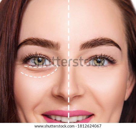 Female face before and after plastic surgery anti wrinkle under eyes.
