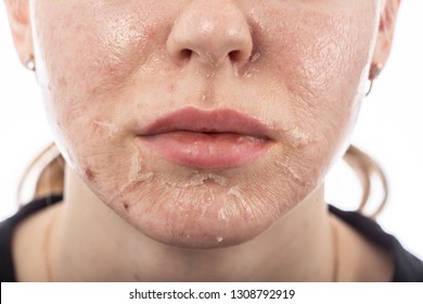 female face with burned skin after chemical peeling - Shutterstock ID 1308792919