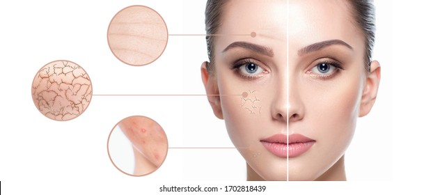 Female face close-up, showing skin problems. Dry skin, acne, wrinkles and other imperfections. Rejuvenation, hydration and skin treatment