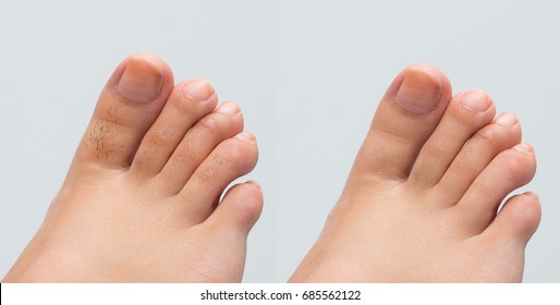 Female Feet Before And After Hair Removal Treatment On Toes