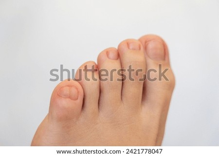 Female feet with big double little toe on white background