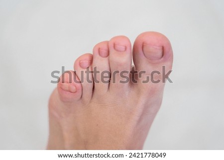 Female feet with a big double little toe on white background