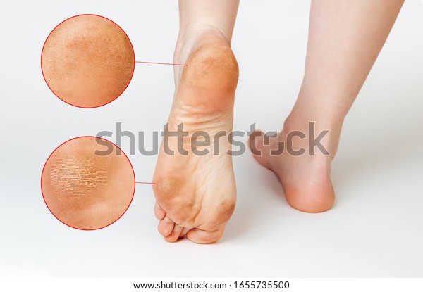 Female feet with corns and calluses, on a white\
background. Foot close-up. Zoomed image of skin lesions.\
Cosmetology and medicine