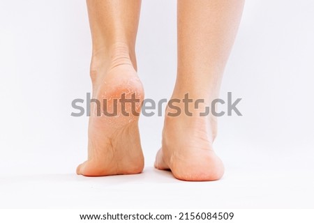 Female feet with cracks and peeling on heels isolated on a white background. Fungal skin infections, allergic diseases, eczema, psoriasis, hyperkeratosis, vitamin deficiency, avitaminos