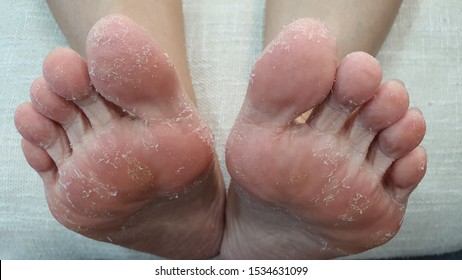 Foot Peeling Images Stock Photos Vectors Shutterstock