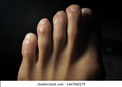 Female Foot With Early Signs Of Hammer Toe