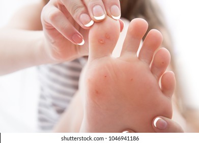 Female Foot With Problem Areas On The Skin, Dry Callus.